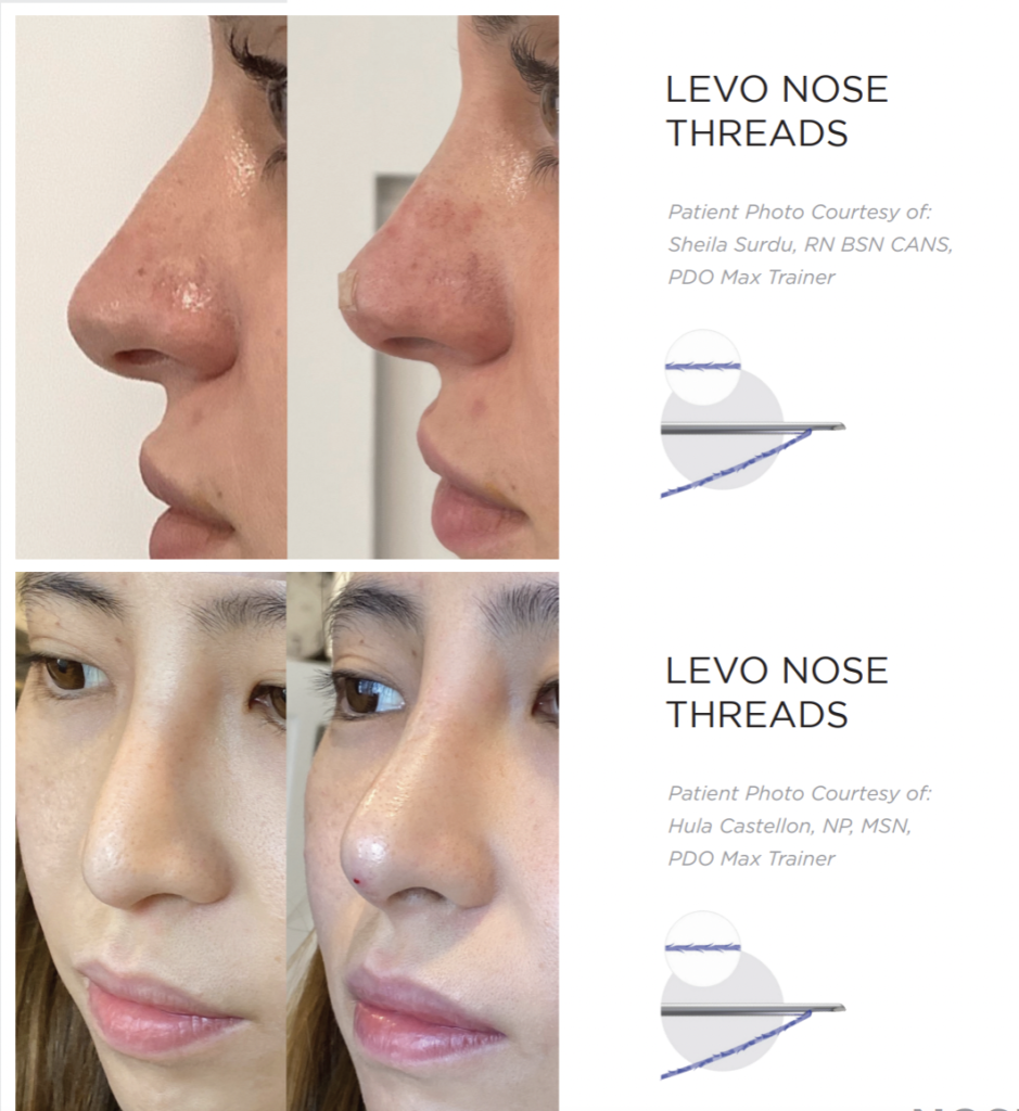 PDO nose threads NYC medspa